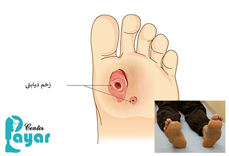 علائم قطع پای دیابتی در افراد دیابتی چیست؟