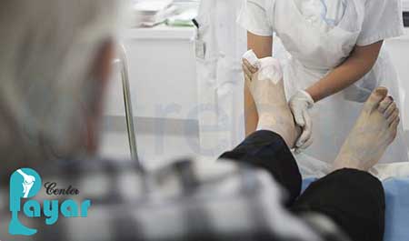 علائم قطع پای دیابتی در افراد دیابتی