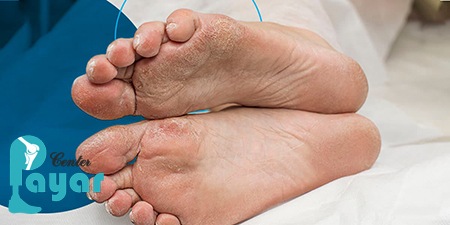 قطع مراحل اولیه زخم پای دیابتی در خانه