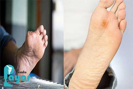 هر آنچه که باید در مورد قطع مراحل اولیه زخم پای دیابتی بدانید