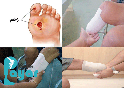 چرا کار به قطع پای دیابتی می رسد