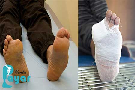 چند تا از مراقبت های بعد از عمل قطع انگشت پا در بیماران دیابتی