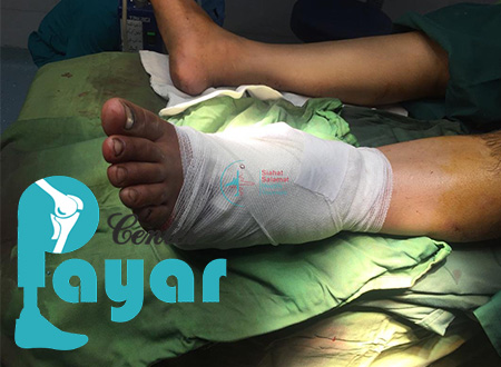 عوارض قطع پا از مچ چیست
