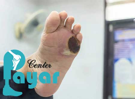 آشنایی با عوارض بعد از قطع پای دیابتی