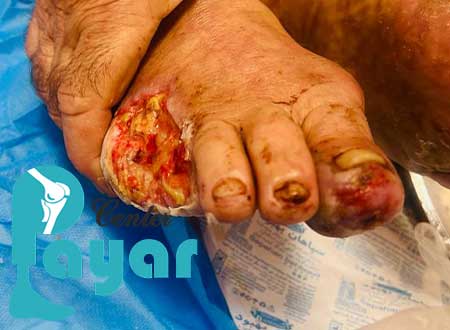 به غیر از قطع پا در اثر عفونت، چه موارد دیگری باعث قطع پا از زیر زانو می شود؟