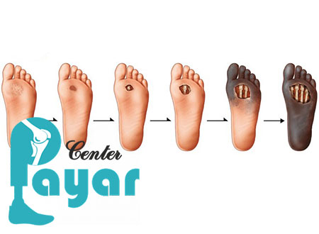 با راهکارهای موثر جهت پیشگیری از قطع مراحل اولیه زخم پای دیابتی آشنا شوید!؟