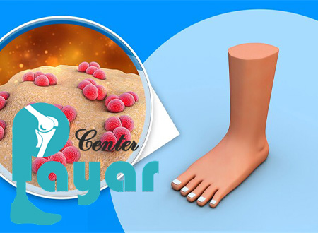 علائم قطع پای دیابتی چیست؟