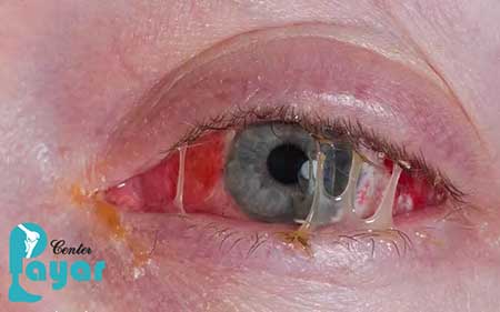 آیا میدانید عفونت چشم دیابتی چیست