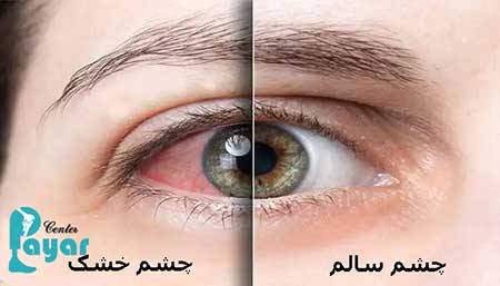 درمان سوزش چشم دیابتی، هر آنچه که باید بدانید