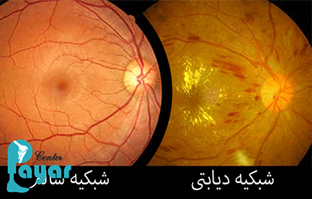 ضرورت بررسی علائم چشم دیابتی
