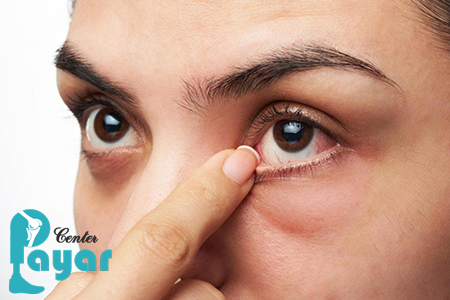 علائم و نشانه های عفونت چشم دیابتی