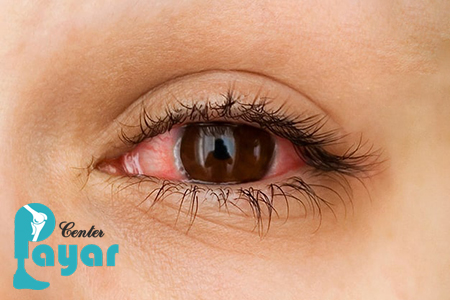 علت عفونت چشم دیابتی چیست؟ در مورد آن چه میدانید؟