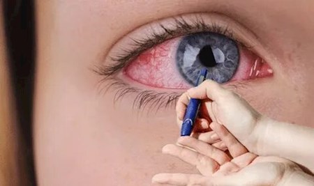 چه کسانی می بایست نگران علائم چشم دیابتی و تاثیر قند بر شبکیه چشم باشند؟
