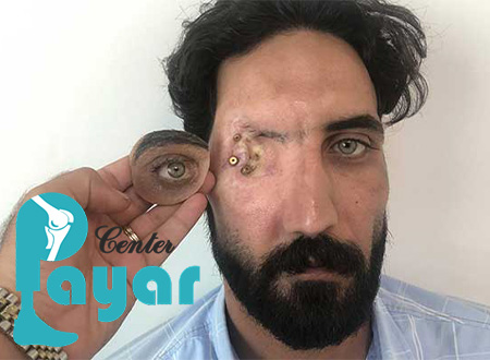 پروتز چشم اوربیتال