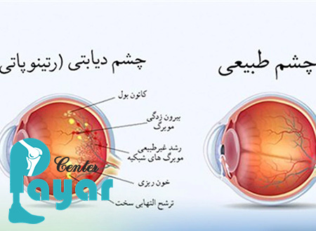 علائم چشم دیابتی چیست