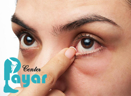 چگونه از بروز علائم چشم دیابتی جلوگیری کنیم؟