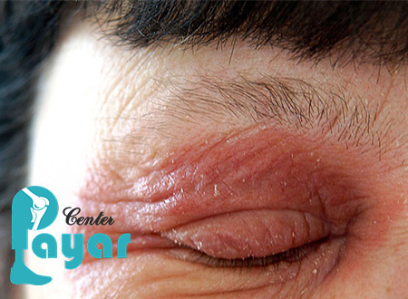 رابطه بین عفونت چشم دیابتی و خشکی چشم چیست؟