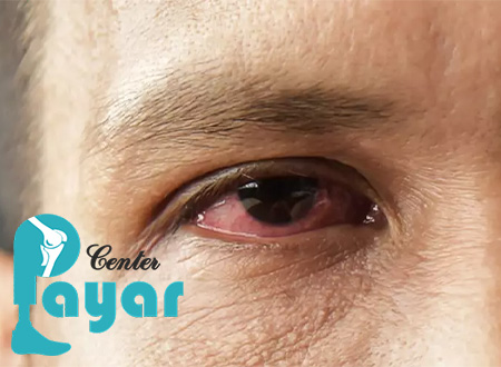 درمان سوزش چشم دیابتی هر آنچه که باید بدانید