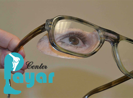 پروتز چشم اوربیتال چیست