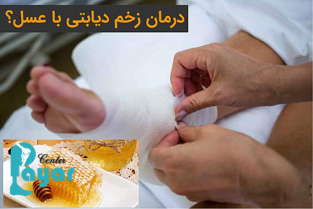 آیا درمان زخم پای دیابتی با عسل، یک درمان قطعی زخم پای دیابتی در طب سنتی است؟