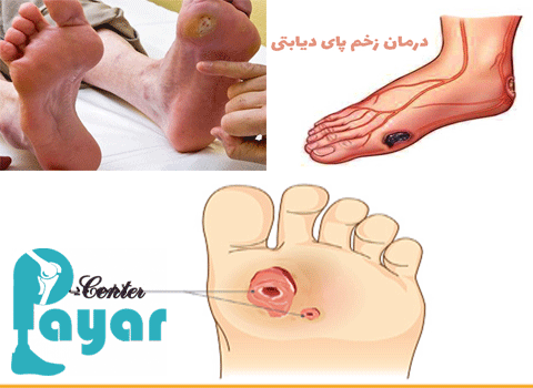 آیا درمان قطعی زخم پای دیابتی در طب سنتی امکان پذیر است