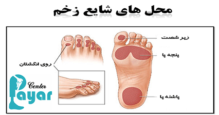 انواع زخم پای دیابتی را بهتر بشناسیم