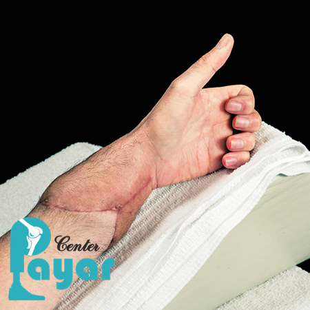 ایا پیوند دست امکان پذیر است؟ در این مورد چه میدانید؟