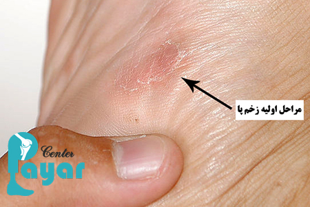 علائم زخم پای دیابتی چیست؟ انواع زخم پای دیابتی چه علائمی دارد؟