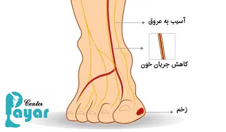 مدت زمان درمان انواع زخم پای دیابتی