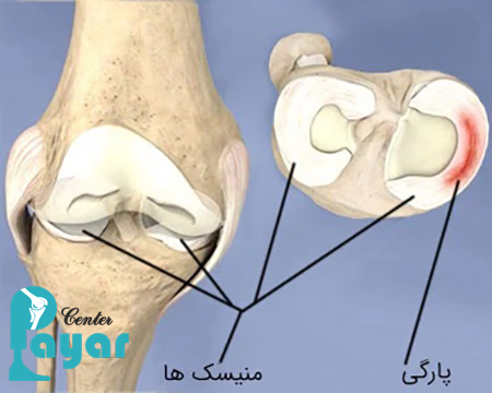 در مورد بدترین عوارض درمان نکردن مینیسک زانو چه میدانید؟