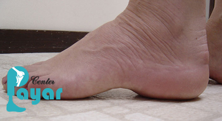 کفش مناسب کف پای قوس دار