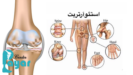 استئوآرتریت چیست