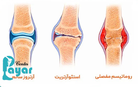 بهترین روش درمان استئوآرتریت چیست؟