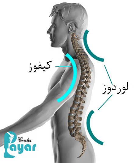 تفاوت لوردوز و کیفوز