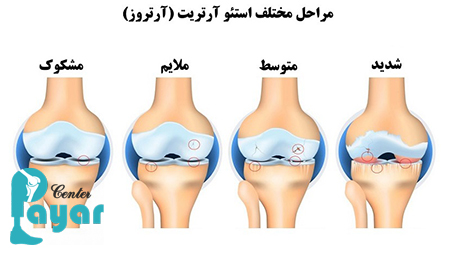 علت استئوآرتریت چیست