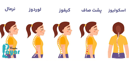 عوارض لوردوز کمری چیست؟ تفاوت لوردوز و کیفوز از نظر عوارض چیست؟