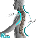 تفاوت لوردوز و کیفوز چیست؟ بررسی هر کدام