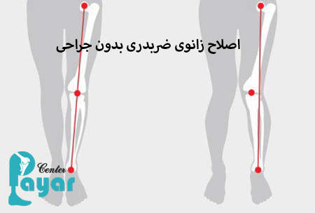 اصلاح زانوی ضربدری بدون جراحی چگونه است