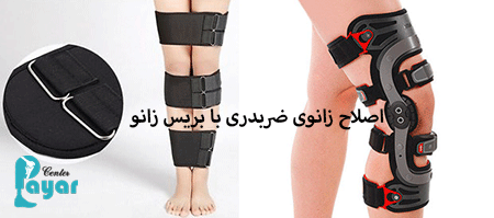 بریس و درمان زانوی ضربدری