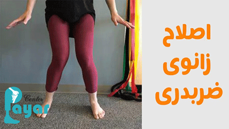 بهترین روش درمان زانوی ضربدری