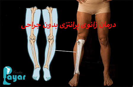 بهترین روش درمان زانوی پرانتزی بدون جراحی چیست