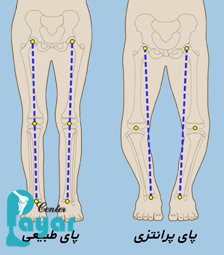 زانوی پرانتزی چیست