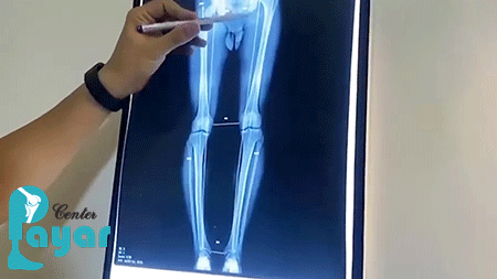 نحوه تشخیص زانوی پرانتزی چگونه است
