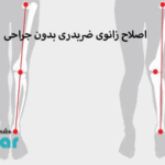 اصلاح زانوی ضربدری بدون جراحی⭐اصلاح با زانو بند طبی