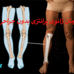 درمان زانوی پرانتزی بدون جراحی⭐اصلاح با زانو بند طبی