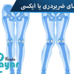 زانو ضربدری (ژنووالگوم) چیست؟⭐هر آنچه باید بدانید
