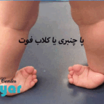 درمان کلاب فوت بدون جراحی⭐با ارتز و کفش طبی