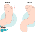 علت کلاب فوت چیست؟⭐علت کلاب فوت (پا چنبری)