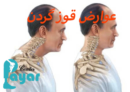 آیا میدانید عوارض قوز گردن چیست