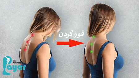 قوز گردن چیست